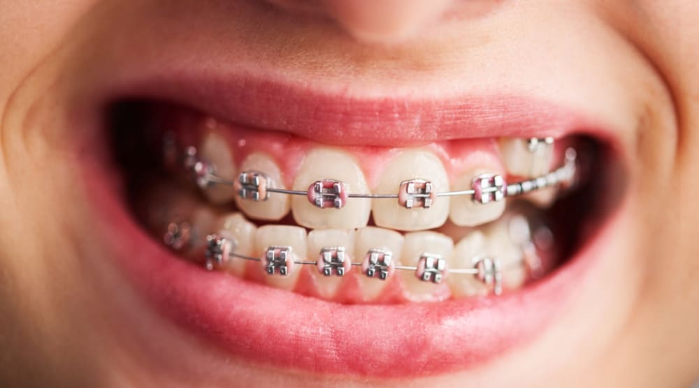 Benefits of orthodontic treatment