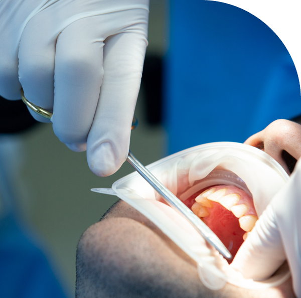 Dentist performing cavity filling with composite material